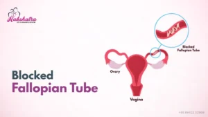 Blocked Fallopian Tubes: Causes, Symptoms, Diagnosis, and Treatment
