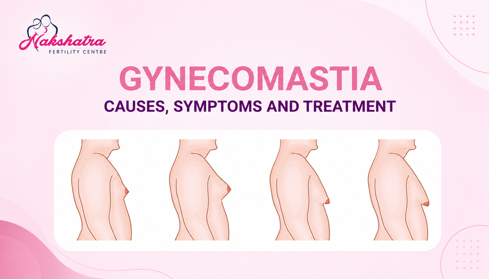 Does Gynecomastia Cause Infertility: Causes, Symptoms, Diagnosis, Treatment