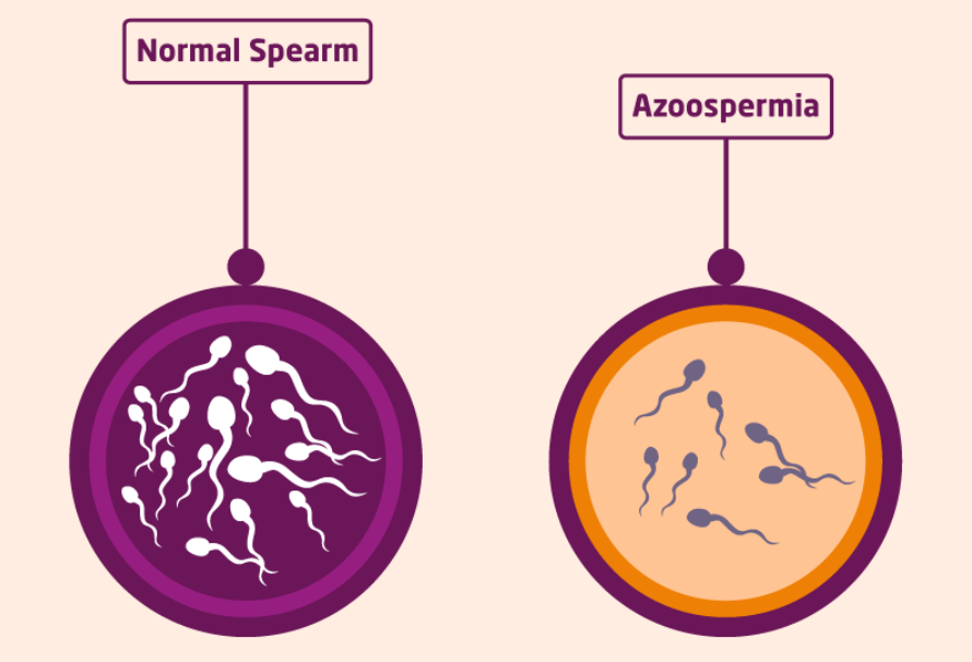 Can Men with Azoospermia Become Fathers? Advanced Treatments in Chennai